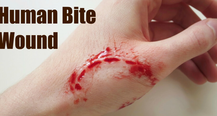 How To Tell If A Human Bite Wound Is Infected