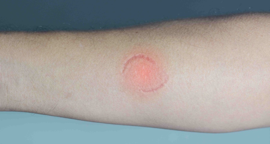ringworm from mosquito bite